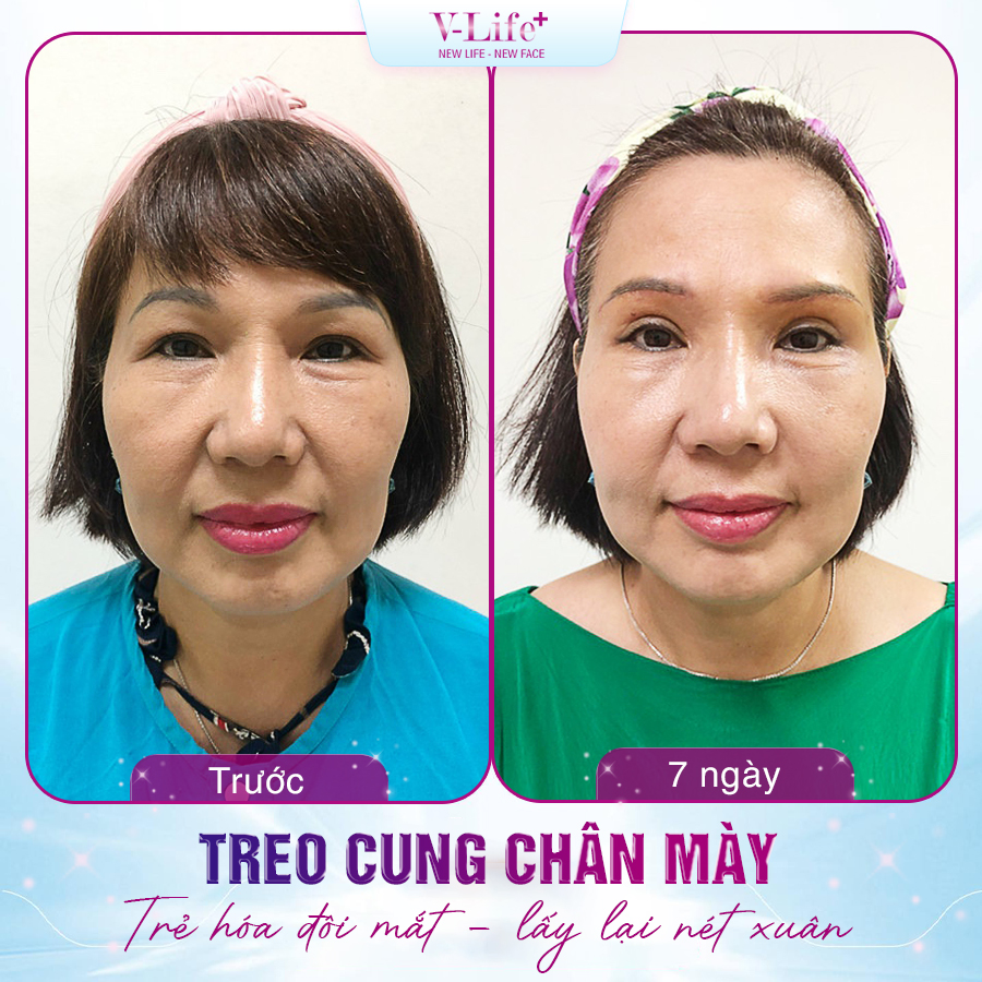 Treo chân mày đơn thuần