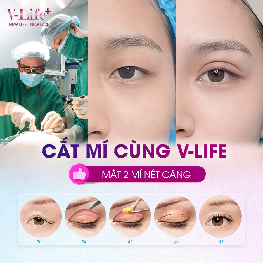 Tạo hình mắt hai mí
