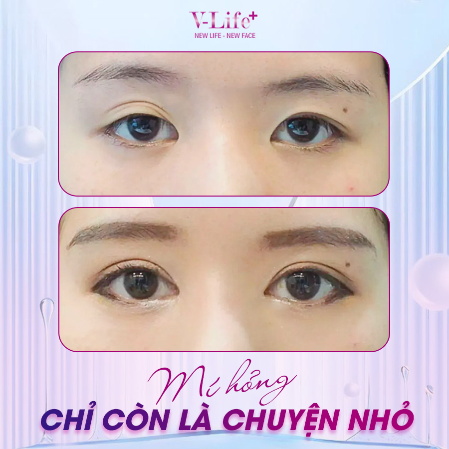 Sửa lại mí mắt trên (bị cắt hư)