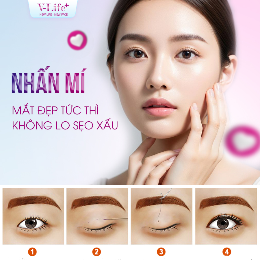 Nhấn mí không phẫu thuật