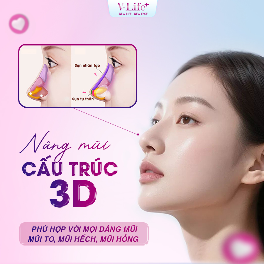 Nâng mũi 3D (mũi cấu trúc)