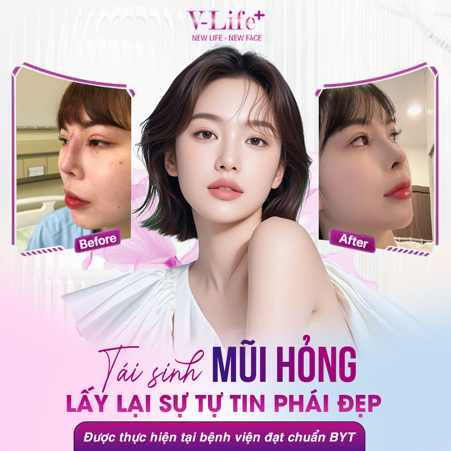 Sửa lại mũi không thay Silicone