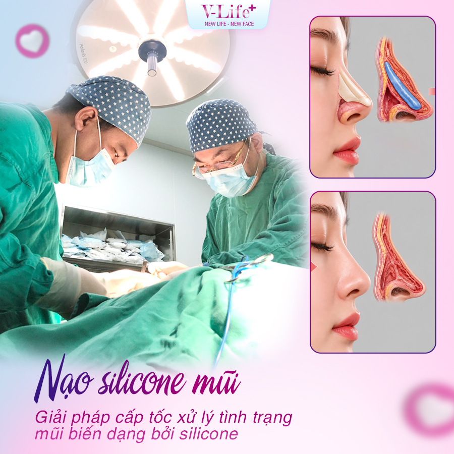 Nạo, lấy Silicon cứng
