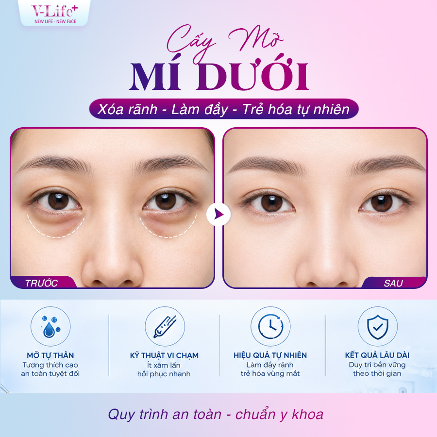 Cấy mỡ mi dưới