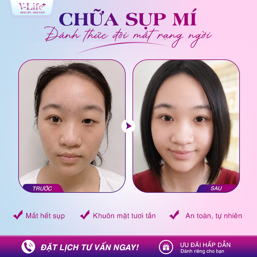 Chữa sụp mi