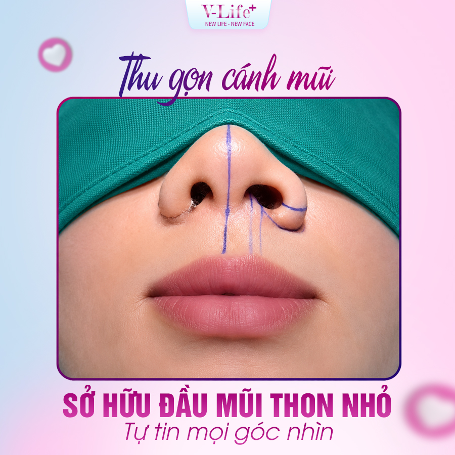 Cắt cánh mũi
