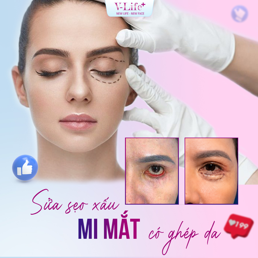 Sửa sẹo xấu mi mắt (có ghép da)