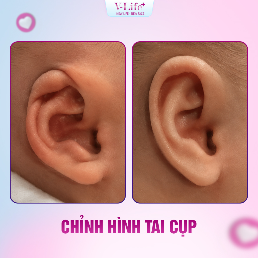 Chỉnh hình tai cụp