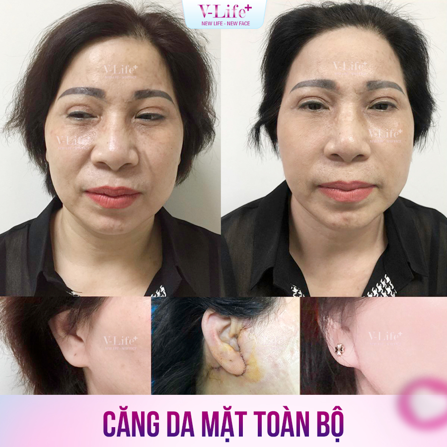 Căng da mặt toàn bộ
