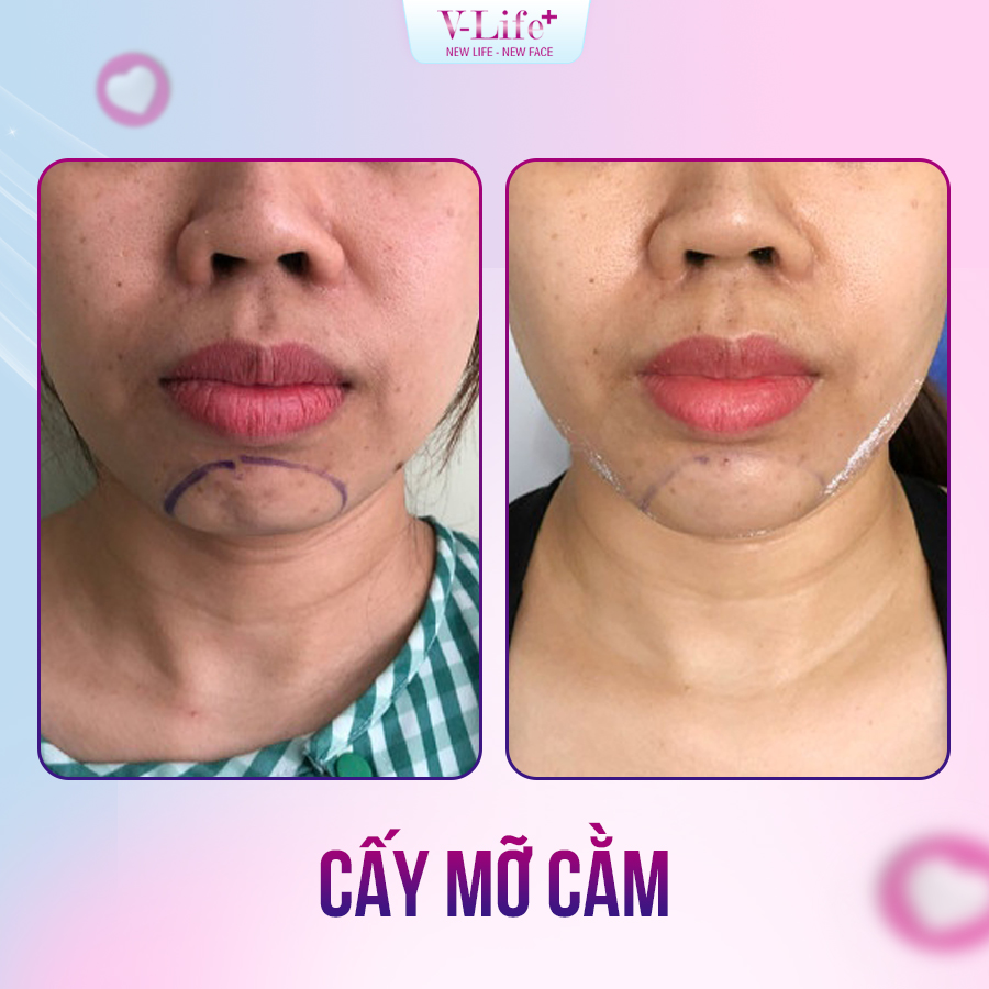 Cấy mỡ cằm