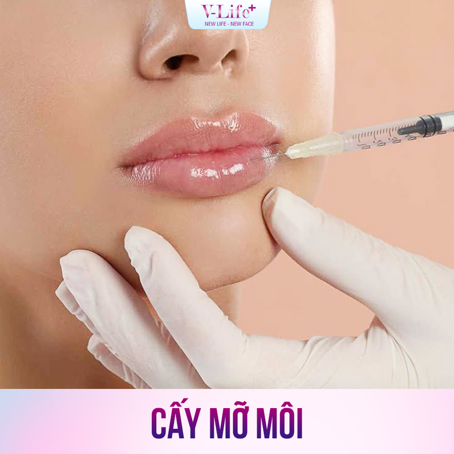 Cấy mỡ môi
