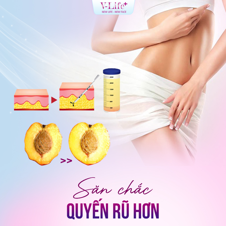 Cấy mỡ môi lớn