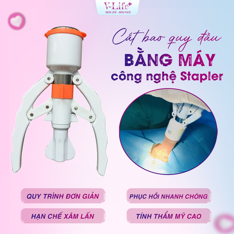 Cắt bao quy đầu bằng máy
