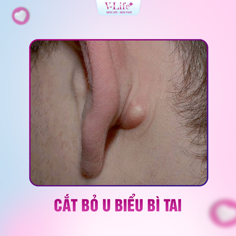Cắt bỏ U biểu bì tai