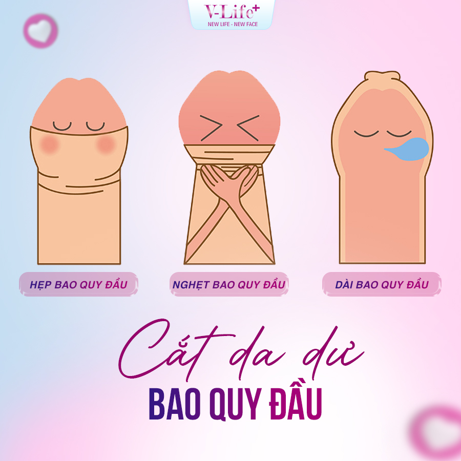 Cắt da dư bao quy đầu