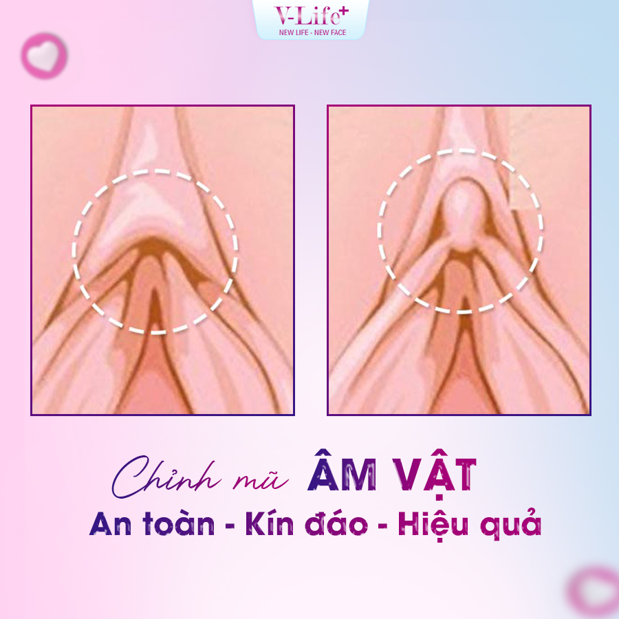 Cắt da dư mũ âm vật