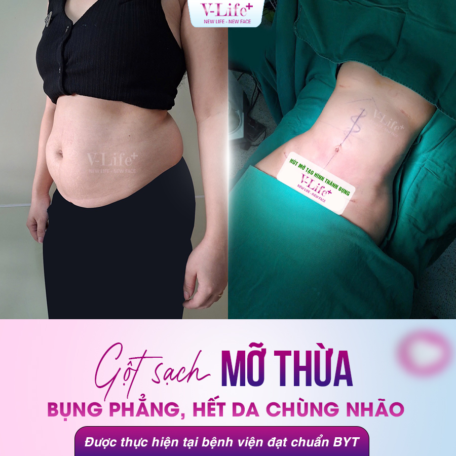 Hút - cắt mỡ thừa và tạo hình thành bụng dưới
