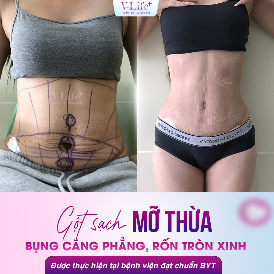 Hút - cắt mỡ thừa, tạo hình thành bụng dưới và trên, có tạo hình rốn