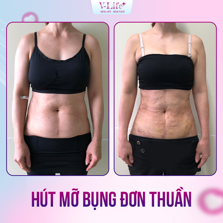 Hút mỡ bụng đơn thuần