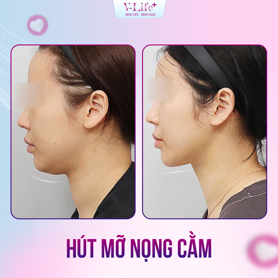 Hút mỡ nọng cằm