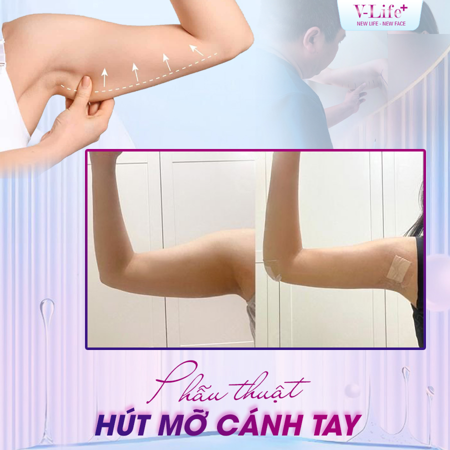 Hút mỡ cánh tay