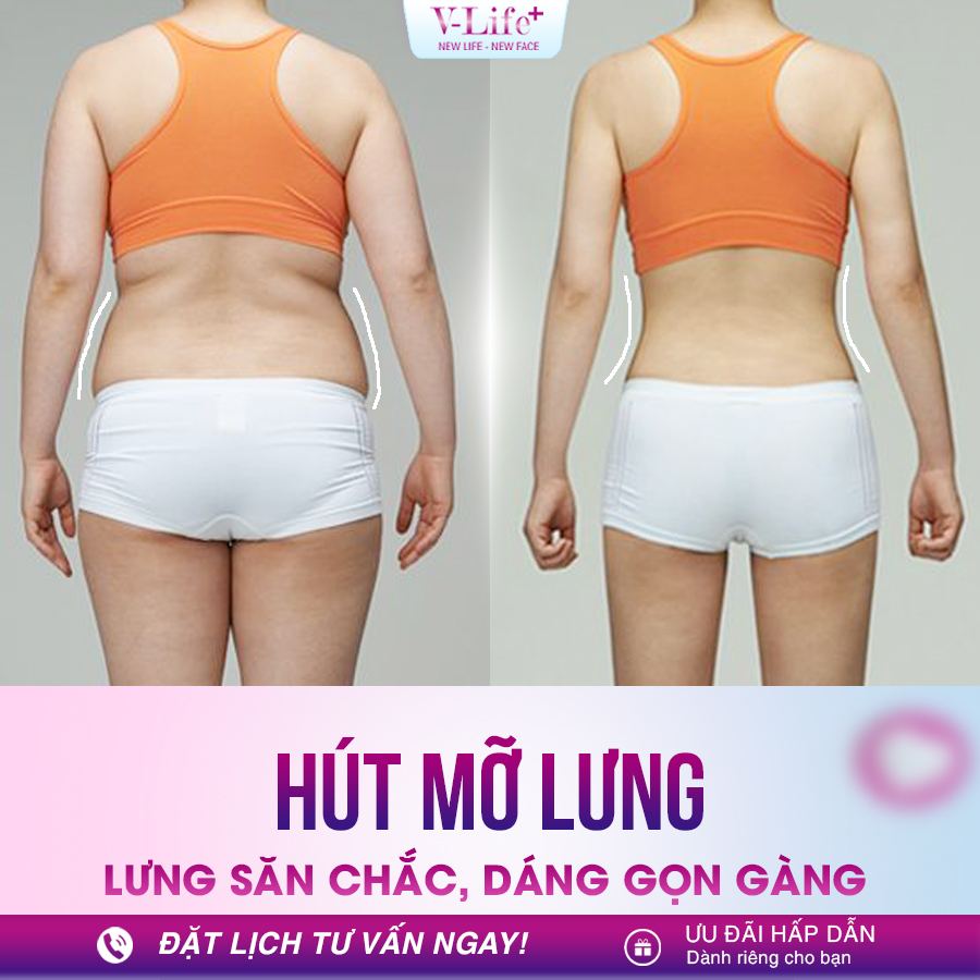 Hút mỡ lưng