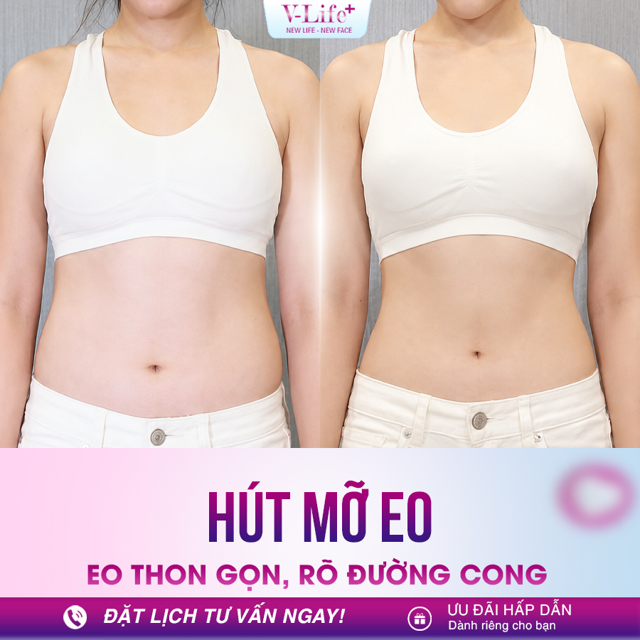 Hút mỡ eo