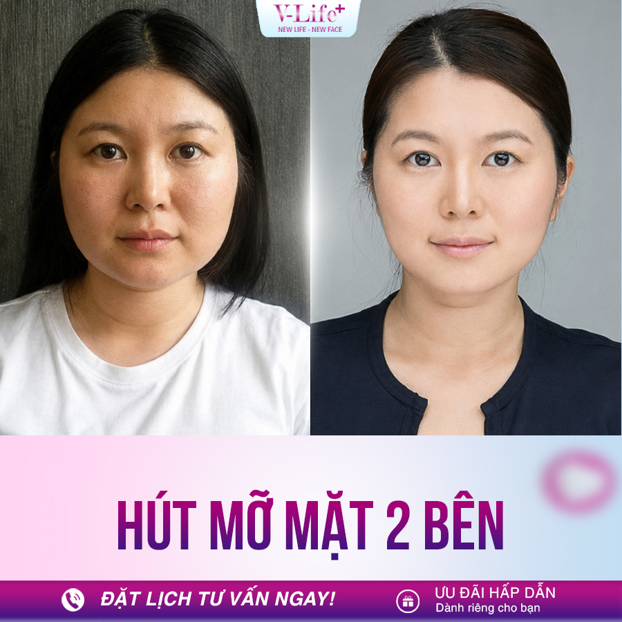 Hút mỡ mặt 2 bên