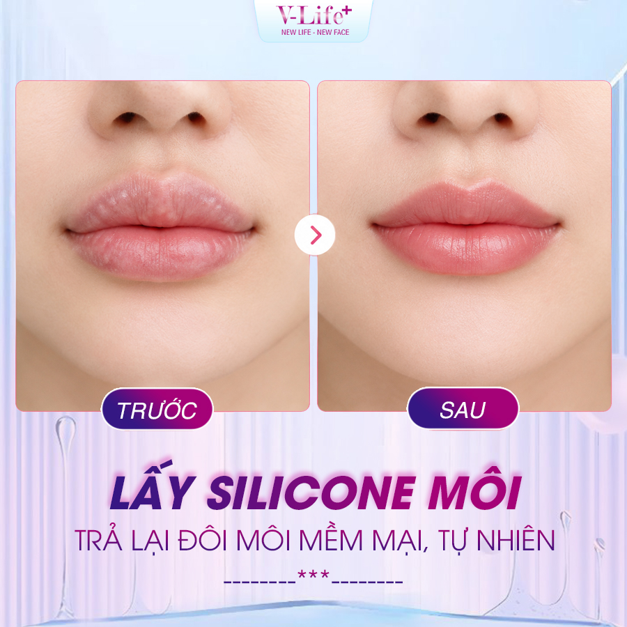 Lấy Silicon môi