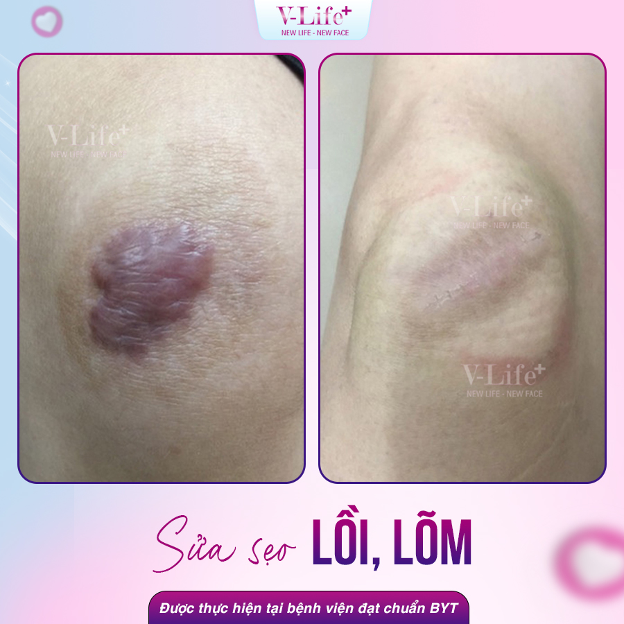 Sửa sẹo lồi, lõm