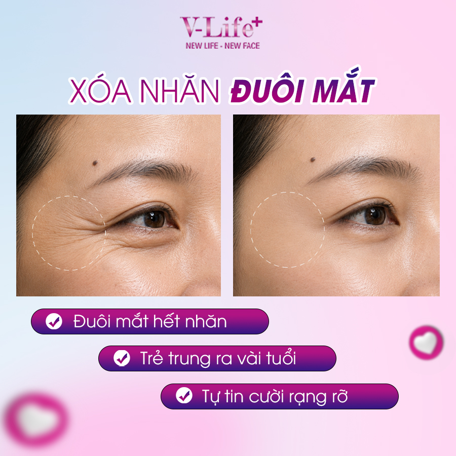 Tiêm Botox xóa nếp nhăn đuôi mắt
