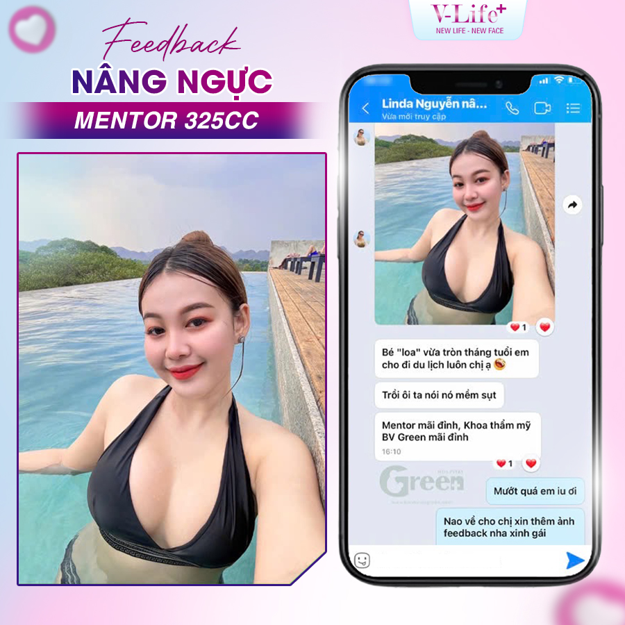 Nâng ngực bằng túi thường