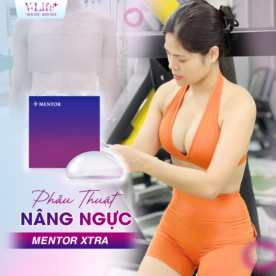 Nâng ngực bằng túi Mentor Xtra