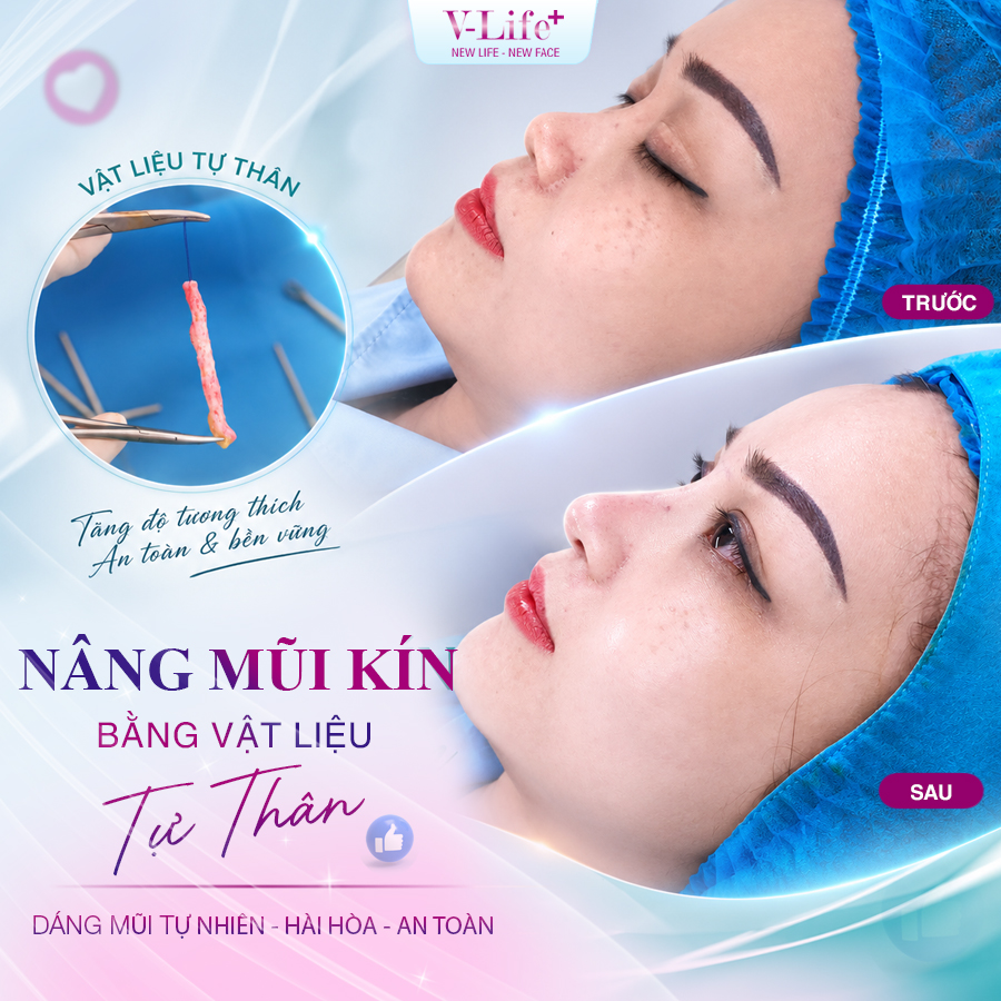 Nâng mũi kín bằng vật liệu tự thân