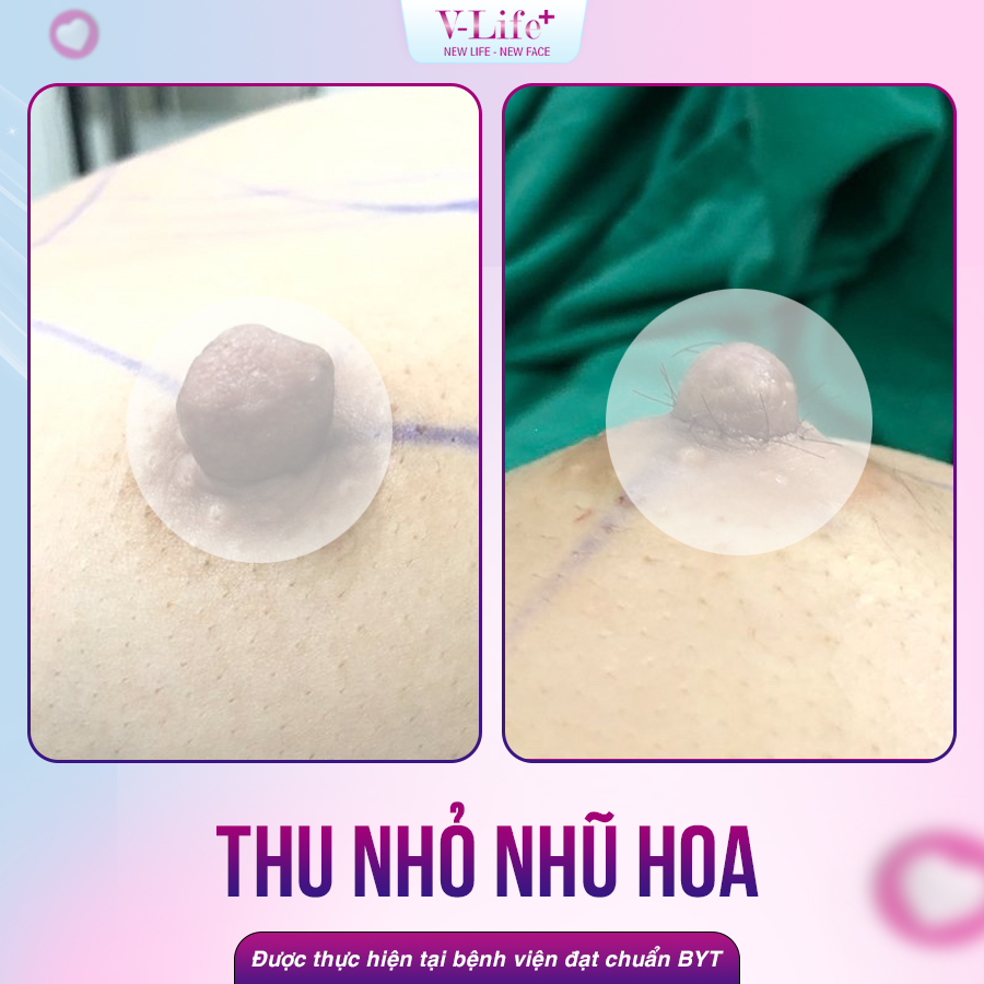 Thu nhỏ đầu vú