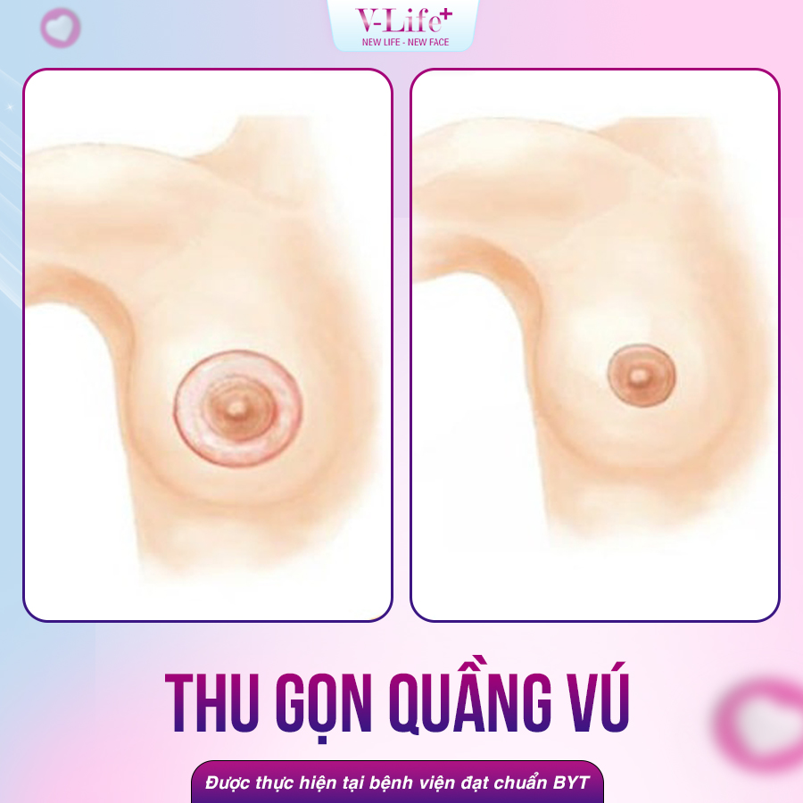 Thu gọn quầng vú