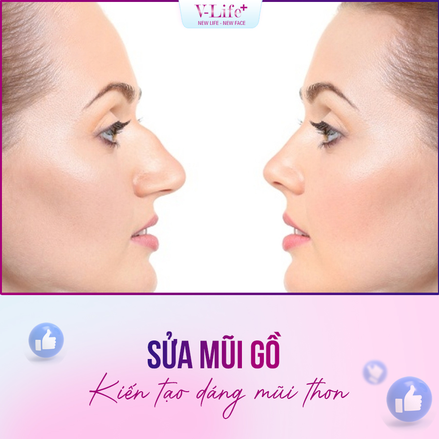 Sửa mũi gồ