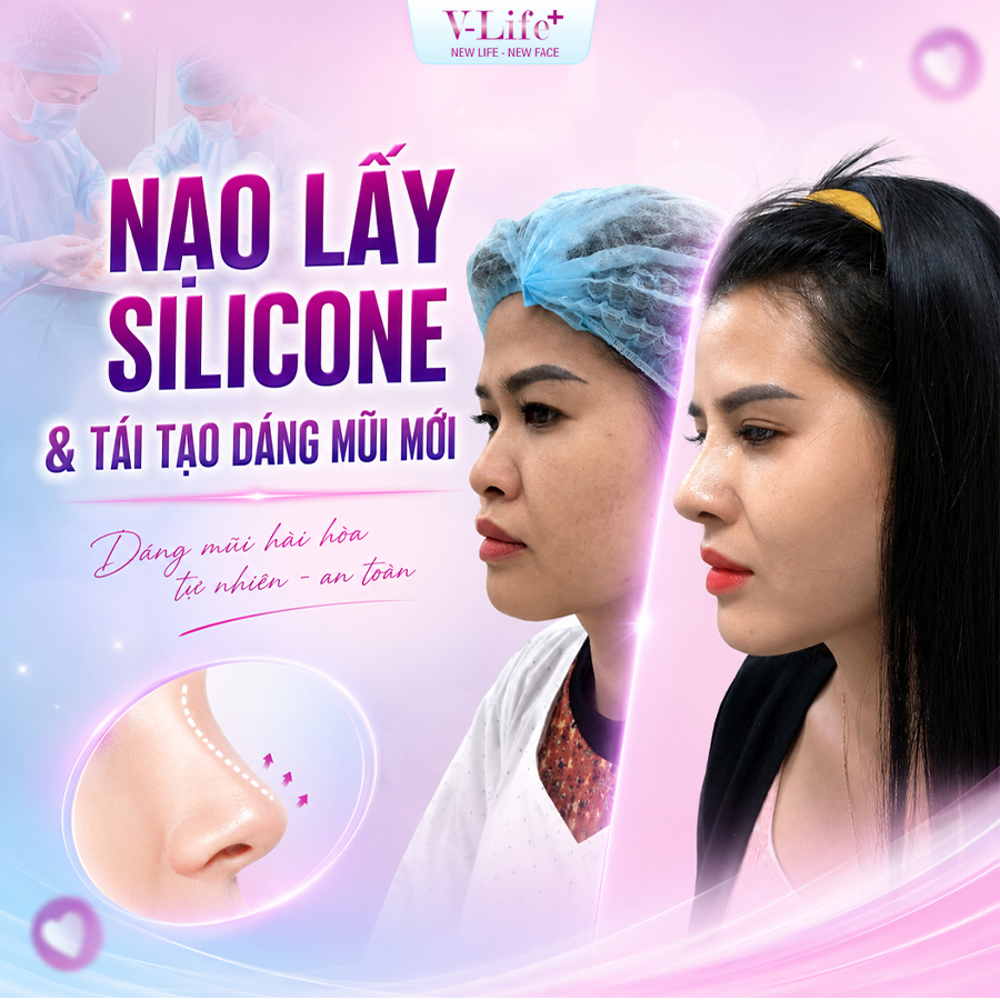 Nạo, lấy Silicon và làm lại sống mũi mới