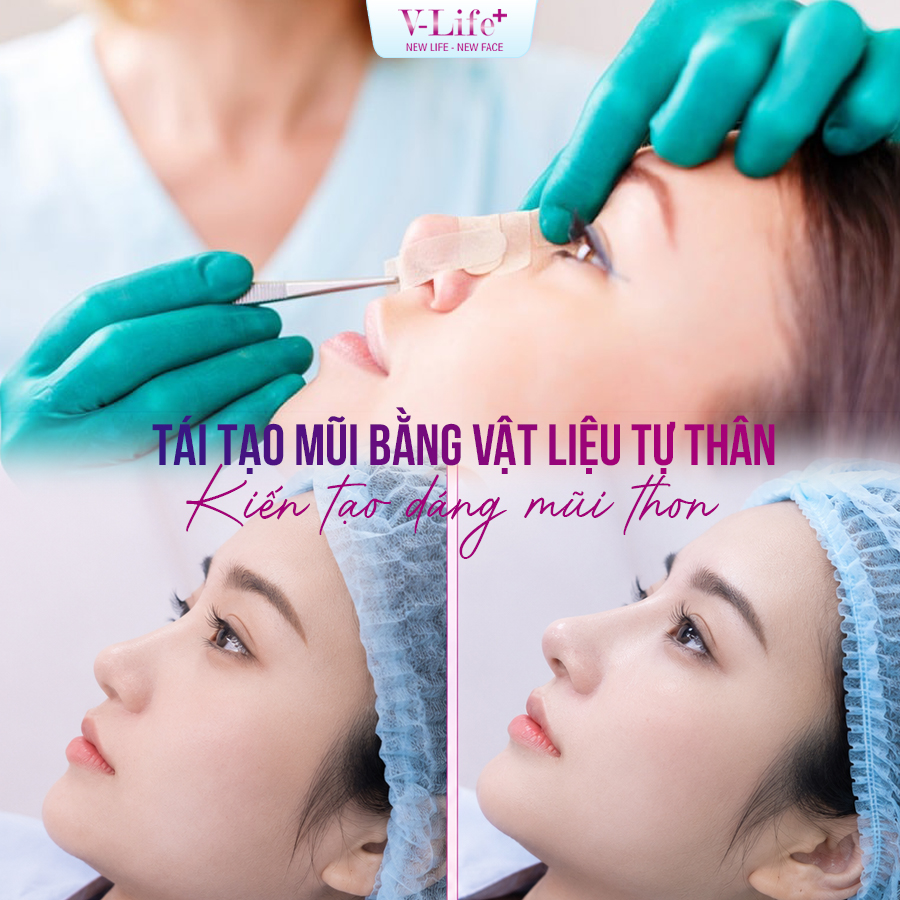 Nạo, lấy silicon và tái tạo đặc biệt lấy vật liệu tự thân
