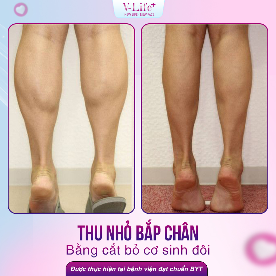 Thu nhỏ bắp chân bằng cắt bỏ cơ sinh đôi