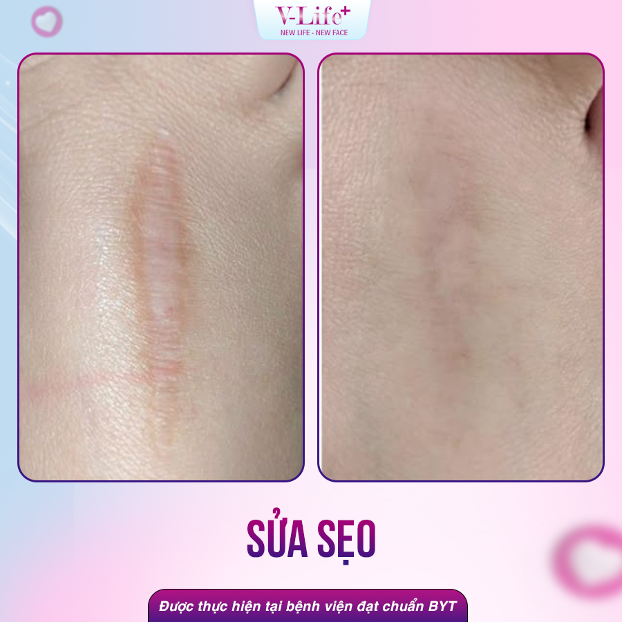Sửa sẹo đơn giản