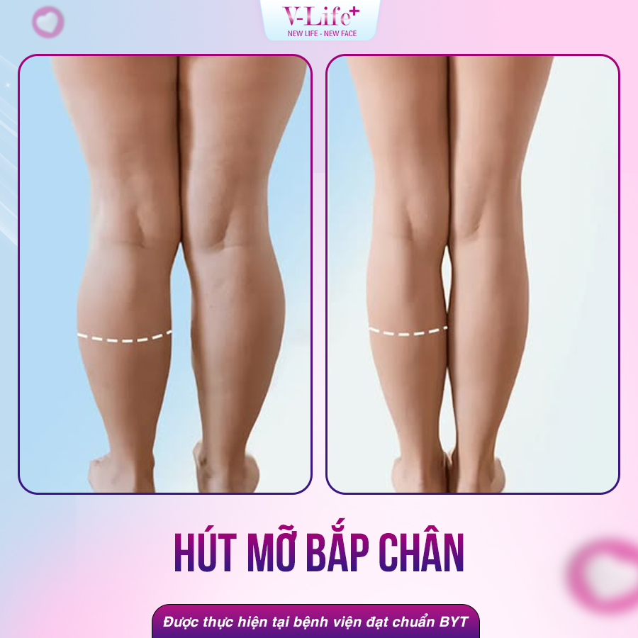 Thu nhỏ bắp chân bằng hút mỡ