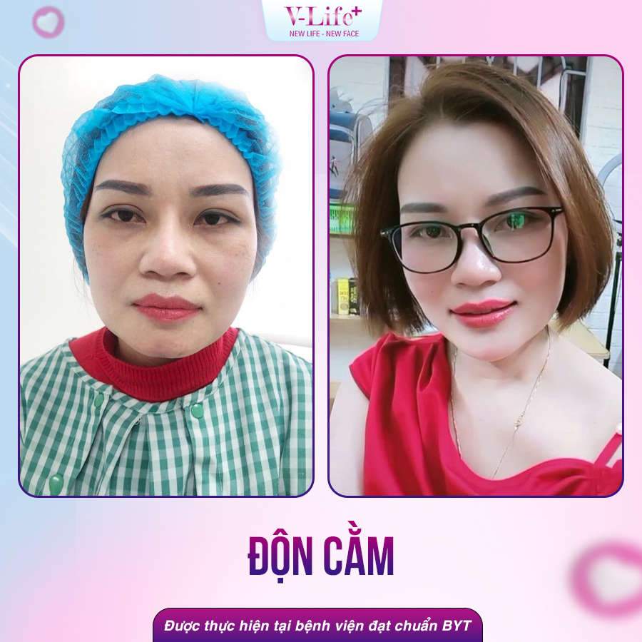 Độn cằm