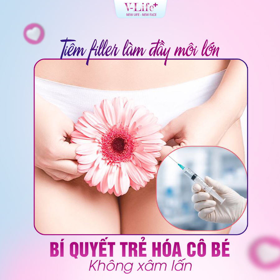 Tiêm filler môi lớn
