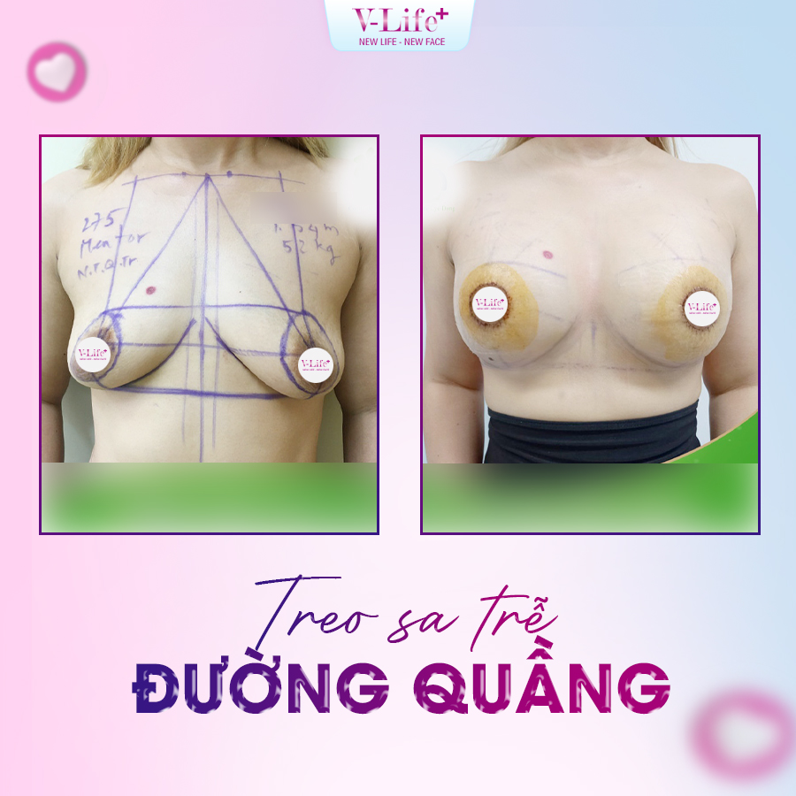 Treo sa trễ đường quầng