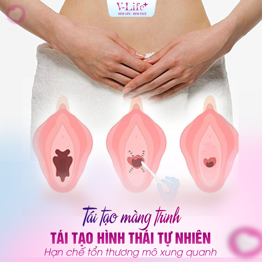 Tái tạo màng trinh