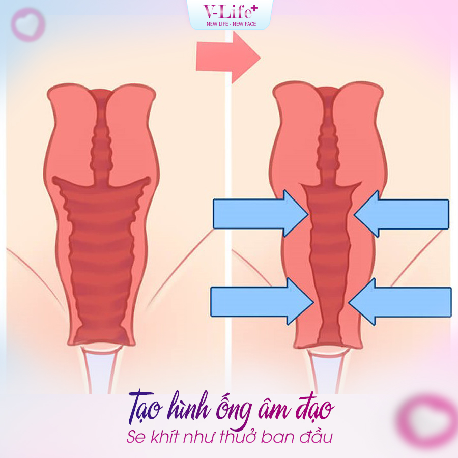 Tạo hình ống âm đạo