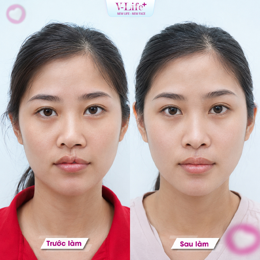 Tạo hình dị tật mũi môi