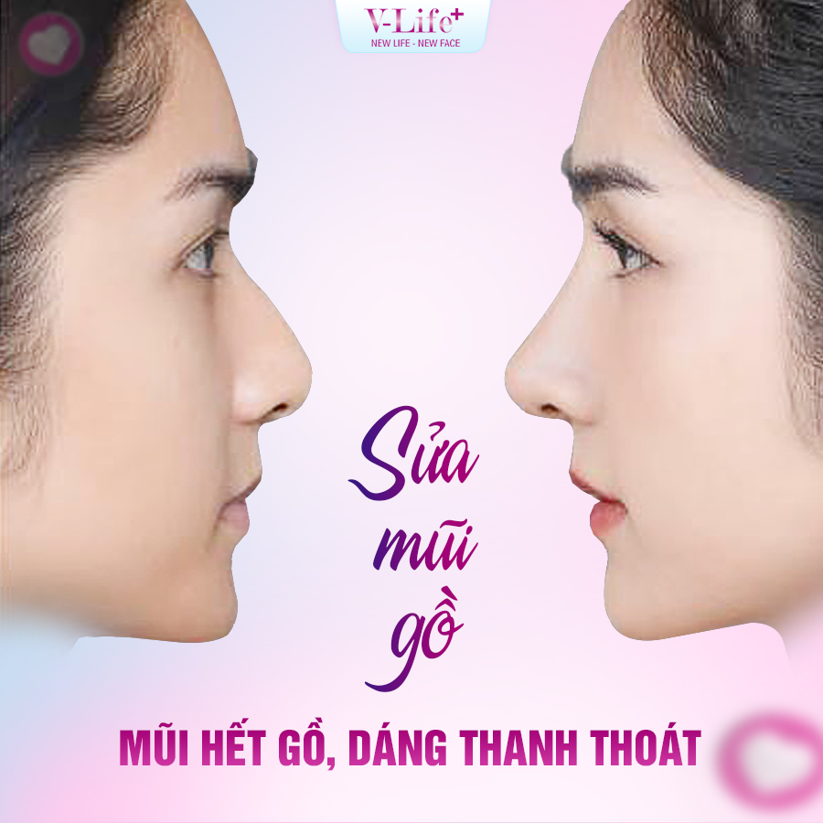 Sửa mũi gồ