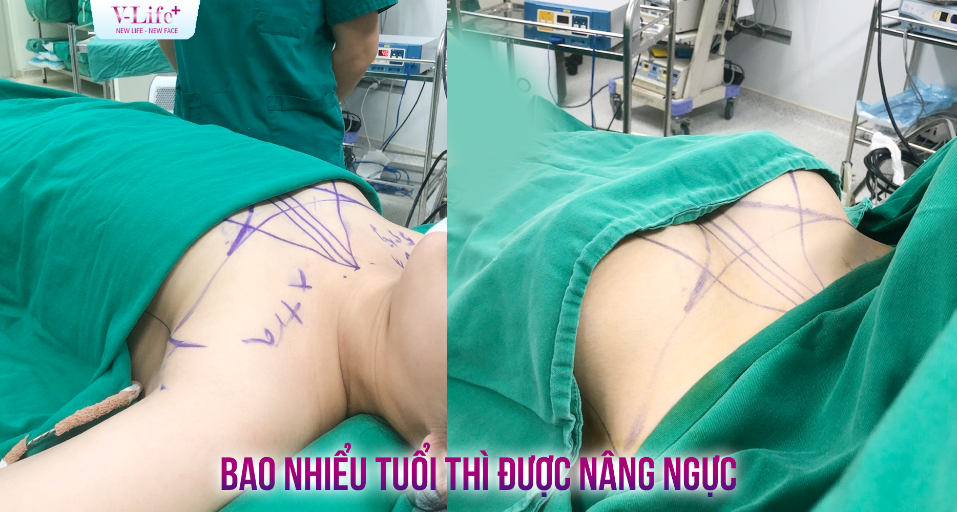Bao nhiêu tuổi thì được nâng ngực? Người trẻ có nên nâng ngực?